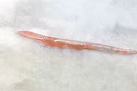 Người đàn ông bị xương cá dài cắm sâu vào lưỡi gây... tụ dịch nhiễm trùng