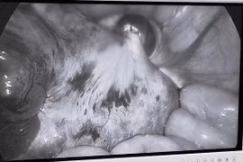 Đau bụng, nôn ói, bé gái 9 tuổi không ngờ mắc u buồng trứng xoắn