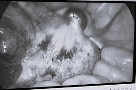 Đau bụng, nôn ói, bé gái 9 tuổi không ngờ mắc u buồng trứng xoắn