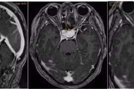 Đau nửa đầu, đi khám bất ngờ phát hiện mắc bệnh nguy hiểm ở não