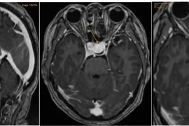 Đau nửa đầu, đi khám bất ngờ phát hiện mắc bệnh nguy hiểm ở não
