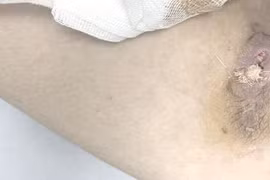 Người đàn ông 36 tuổi nguy kịch do nhiễm "vi khuẩn ăn thịt người"