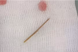 Bé 6 tuổi thủng ruột vì... nuốt tăm tre dài 4cm