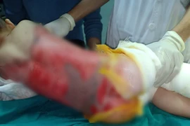 Tuyên Quang: Cảnh báo nhiều trẻ nhỏ bị bỏng nước sôi