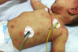 Phòng bệnh nhiễm não mô cầu