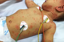 Phòng bệnh nhiễm não mô cầu