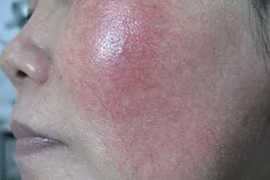 Teo, nứt da, nhiễm ký sinh... vì dùng kem trộn 