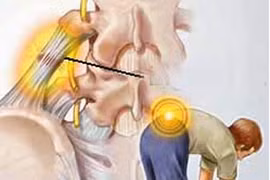 Xoa bóp, kéo đẩy chữa cơn đau do thoát vị đĩa đệm