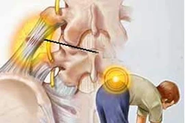 Xoa bóp, kéo đẩy chữa cơn đau do thoát vị đĩa đệm