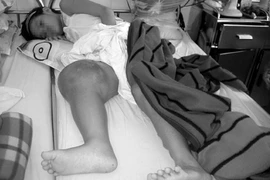 Cắt bỏ hay bảo tồn chi khi bị u xương?