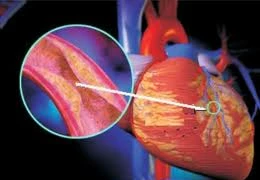 Biểu hiện của bệnh mạch vành