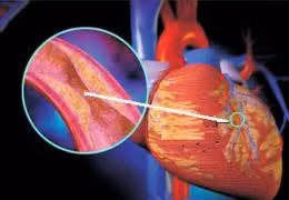 Biểu hiện của bệnh mạch vành