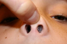 Nhận biết polyp mũi xoang