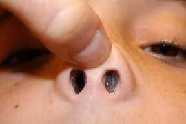 Nhận biết polyp mũi xoang