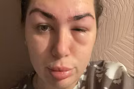 Cô gái “tá hoả” khi suýt bị mù sau lần phun xăm chân mày