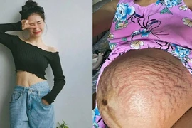 Đặng Thu Thảo bầu đôi bụng rạn chi chít, loạt sao chung cảnh ngộ