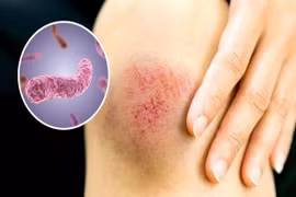 Bé gái 14 tuổi nhiễm “vi khuẩn ăn thịt người”, phòng bệnh thế nào?