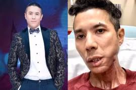 Bệnh viêm khớp xương hàm của Kasim Hoàng Vũ nguy hiểm thế nào?