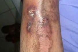 Người đàn ông lở loét chân suốt 2 năm, nấm Candida là “thủ phạm“