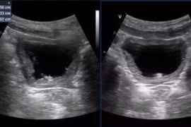 Bé trai 11 tuổi mắc sỏi bàng quang, dấu hiệu bệnh chớ chủ quan