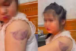 Học sinh lớp 1 nghi bị cô giáo đánh tím tay vì viết xấu