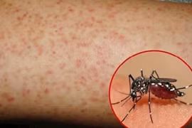 TP HCM: 9 trường hợp tử vong do sốt xuất huyết, nguyên do vì đâu?