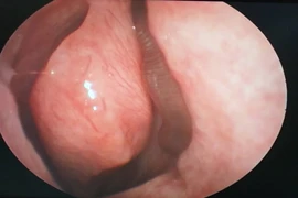 Liên tục chảy máu mũi, người đàn ông đi khám phát hiện dị vật khủng khiếp