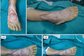 Kỹ thuật ghép da: Chi phí phẫu thuật, thực hiện ở đâu an toàn, hiệu quả?