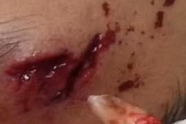 Hãi hùng răng nanh cắm trong trán sau khi va chạm xe