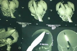 Bé trai bị đâm xuyên đầu: Đã bắt được nghi phạm