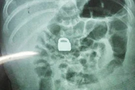 Hãi hùng phát hiện ổ khoá trong bụng bé 2 tháng tuổi