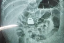 Hãi hùng phát hiện ổ khoá trong bụng bé 2 tháng tuổi