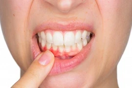 Điều gì xảy ra nếu bạn thường xuyên không đánh răng?