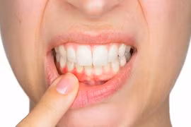 Điều gì xảy ra nếu bạn thường xuyên không đánh răng?