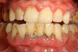 Nhai 3 viên lạc sống trong 5 phút, răng trắng như bọc sứ