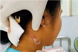 Đồng Nai ghi nhận ca bệnh 'vi khuẩn ăn thịt người' Whitmore 