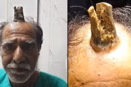 ‘Gốc cây’ cao 10 cm ‘mọc lên’ từ đầu ông lão 74 tuổi 