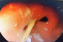 Nam thanh niên bị tăm xỉa răng trôi vào bụng đâm thủng dạ dày 