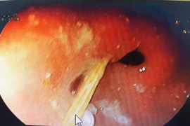 Nam thanh niên bị tăm xỉa răng trôi vào bụng đâm thủng dạ dày 