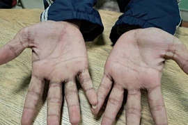 Bị... ghẻ dù rất sạch sẽ