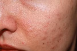 Lý do mụn trứng cá dễ tái phát, khó trị dứt điểm