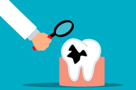 Bật mí "thói quen nhỏ, lợi ích to" giúp ngừa sâu răng hiệu quả