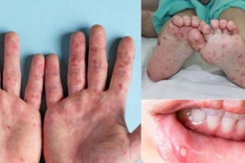 Bài thuốc đông y trị tay chân miệng