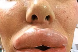 Hoảng hồn với những đôi môi sưng vù vì bơm silicone