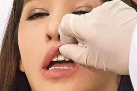 Cận cảnh kỹ thuật bơm môi, cấy mỡ làm đẹp