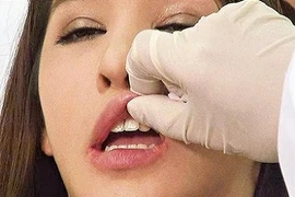 Cận cảnh kỹ thuật bơm môi, cấy mỡ làm đẹp