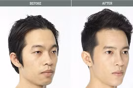 Quý ông tút tát lại nhan sắc bằng phương pháp dao kéo