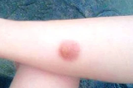 Những điều cần làm ngay khi bị bỏng bô xe máy