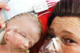 Thương tâm bé sơ sinh có 2 mặt trên một đầu