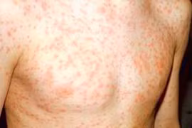 Các biến chứng nguy hiểm của bệnh sởi